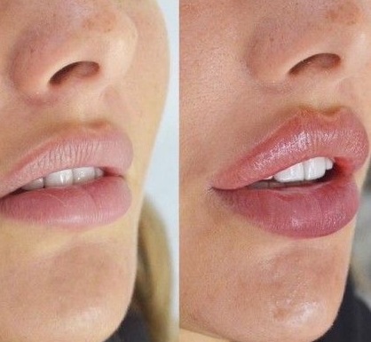 تزریق ژل لب روسی