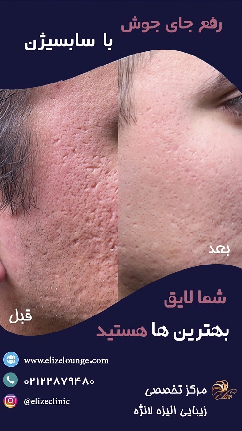 سابسیژن